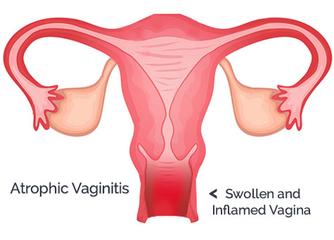 What is Vaginal Atrophy?