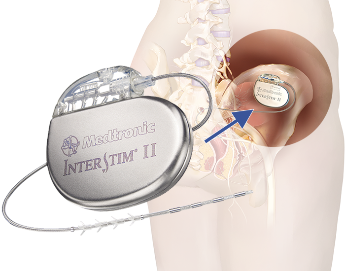 Wireless, Fully Implantable and Expandable Electronic System for  Bidirectional Electrical Neuromodulation of the Urinary Bladder