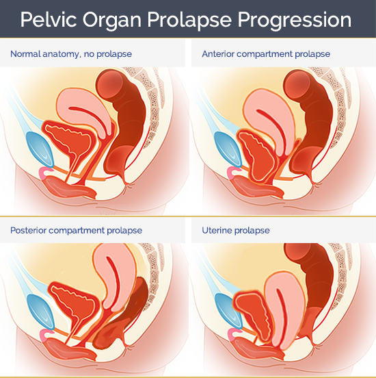 What is Pelvic Organ Prolapse?  Types of Prolapse, Diagnosis